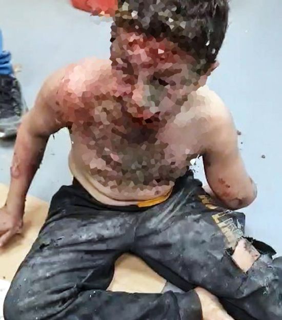 طفل فلسطيني تعرض للحرق (3) طفل فلسطيني تعرض للحرق (3)