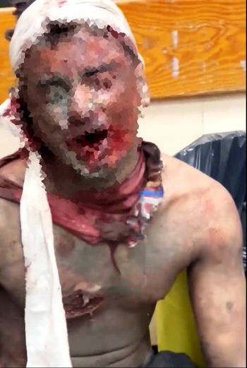 طفل فلسطيني يصرخ بشدة بسبب الحروق القاسية في جسده طفل فلسطيني يصرخ بشدة بسبب الحروق القاسية في جسده