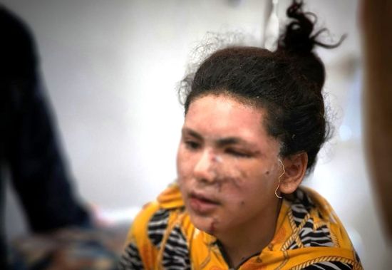 طفلة مصابة طفلة مصابة