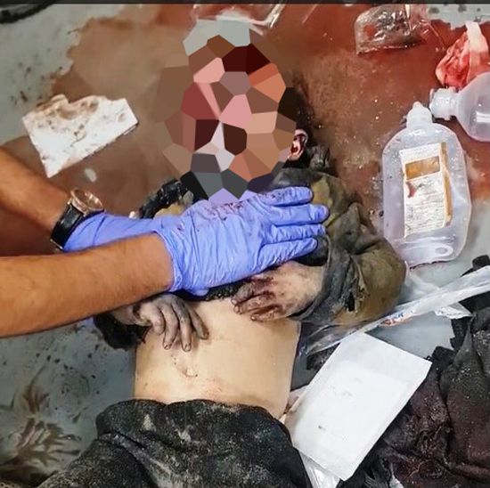 طفل فلسطيني يصرخ من شدة الألم طفل فلسطيني يصرخ من شدة الألم