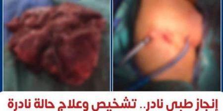 إنجاز طبي نادر، معهد القلب ينجح في تشخيص وعلاج أول حالة موثقة عالميًا لبطانة الرحم داخل الرئة