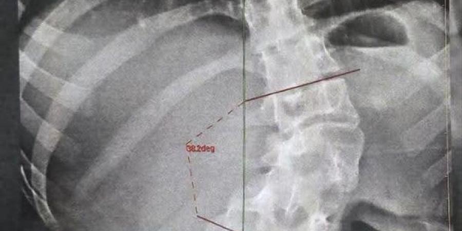 تصحيح شبه كامل لتشوهات العمود الفقري، نجاح جراحة دقيقة لفتاة بمستشفيات بنها الجامعية